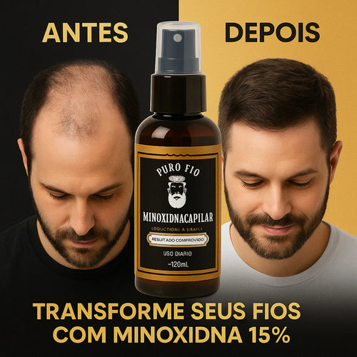 KIT 5X Pro Barber MinoxDNACapilar Spray 120ML Anti Queda Crescimento Barba Cabelo Sobrancelha Bigode 💪 Estimule o Crescimento Natural dos Fios